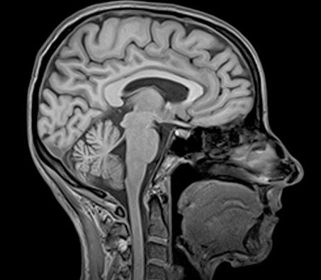 Что показывает МРТ головного мозга и шейного отдела
