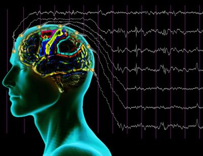 ЭЭГ при эпилепсии: расшифровка результатов. Признаки эпилепсии на ЭЭГ