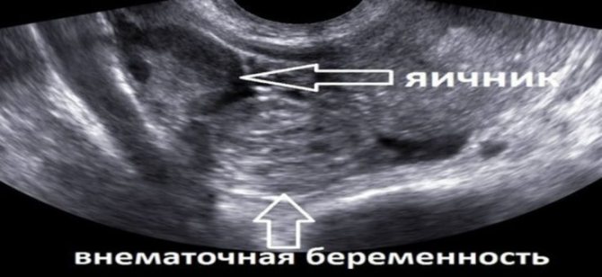 Эктопическая беременность