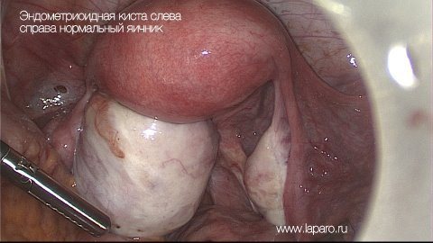 Эндометриоидная киста левого яичника в сочетании с поражением крестцово-маточных связок