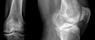 Фото колена на рентгене