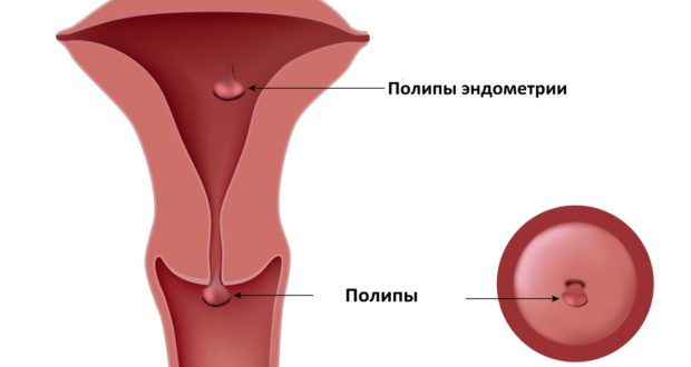 Гистероскопия матки: что это такое в гинекологии и как она проводится