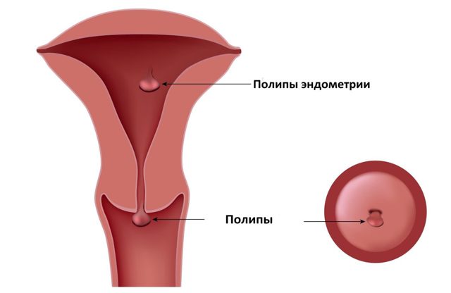 Гистероскопия - удаление полипа в матке: подготовка, проведение и послеоперационный период