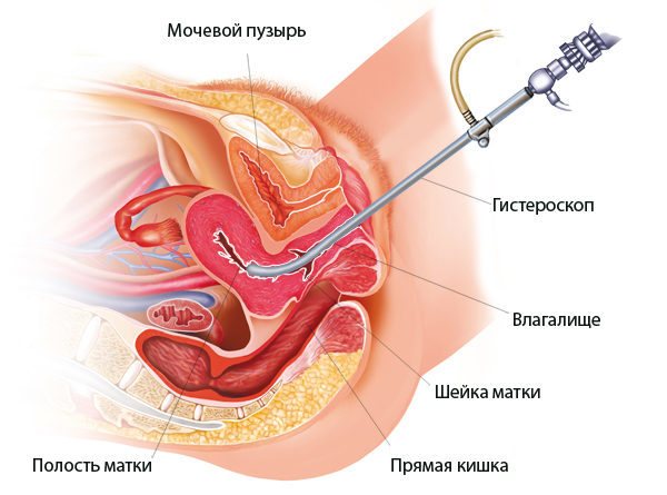 Гистероскопия - удаление полипа в матке: подготовка, проведение и послеоперационный период