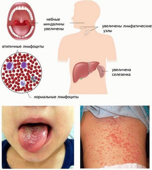 Инфекционный мононуклеоз у детей: симптомы в полости рта, крови и пр фото