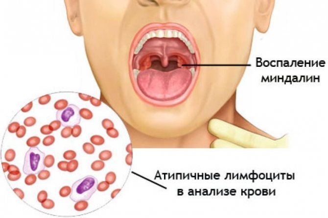 Инфекционный мононуклеоз у детей: симптомы в полости рта, крови и пр фото