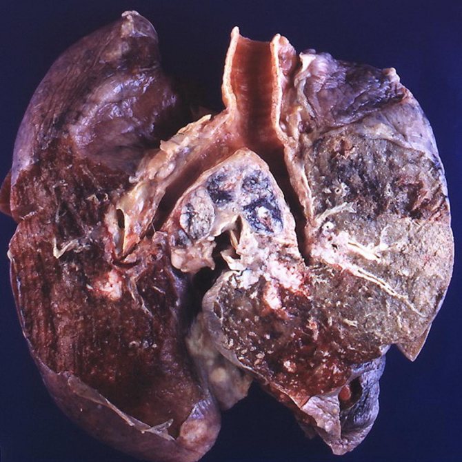Инфильтративный туберкулез легких - фото 5