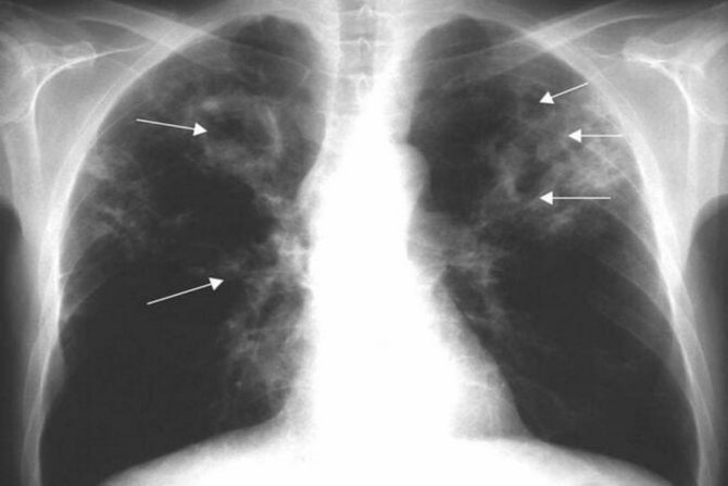 Инфильтративный туберкулез легких: причины и виды
