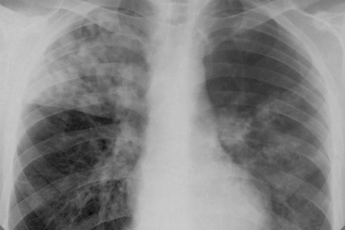 Инфильтративный туберкулез легких: симптомы