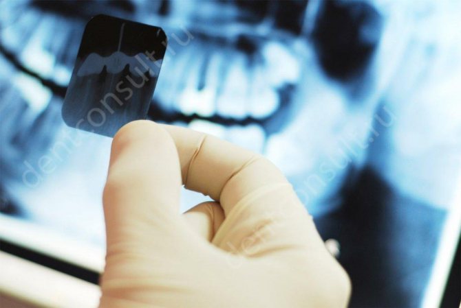 Как часто можно делать рентген зубов взрослому