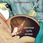 Как проходит операция лапароскопии яичников
