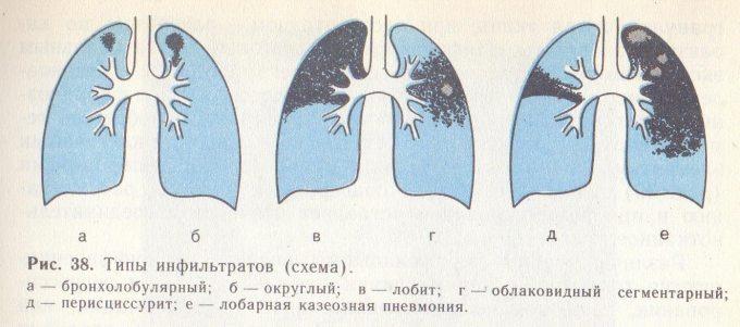 какие разновидности инфильтративного туберкулёза бывают