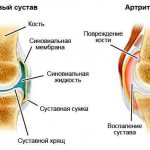 Коленный сустав в норме и при артрите
