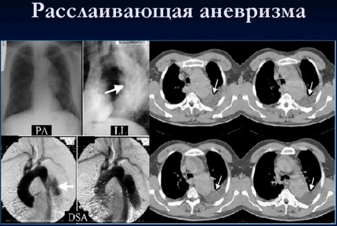 КТ (компьютерная томография) сердца и коронарных сосудов. Как делается, цена