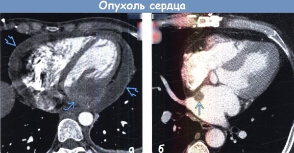 КТ (компьютерная томография) сердца и коронарных сосудов. Как делается, цена