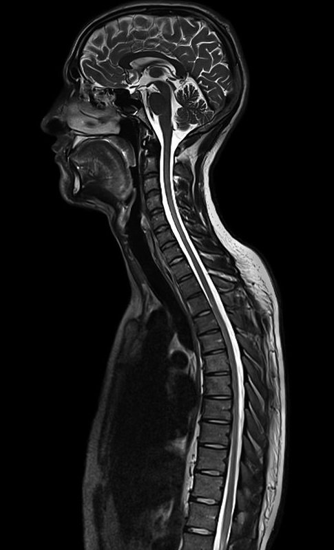 Магнитно-резонансная томография спинного мозга: снимки с контрастом