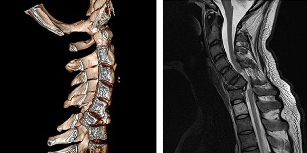 МР-томограмма перелома позвонка шейного отдела