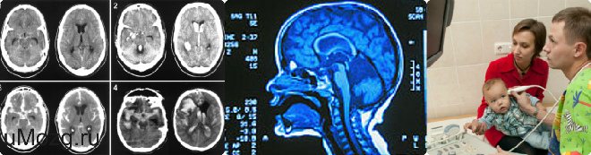 Ишемическая головного мозга новорожденного. НСГ УЗИ головного мозга. Ультразвуковое исследование головного мозга - нейросонография (НСГ). Нейросонография мозолистое тело.