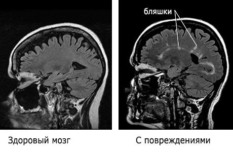 Норма и отклонения МРТ головного мозга