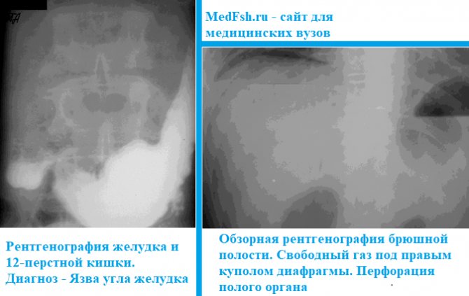 Обзорная рентгенография брюшной полости