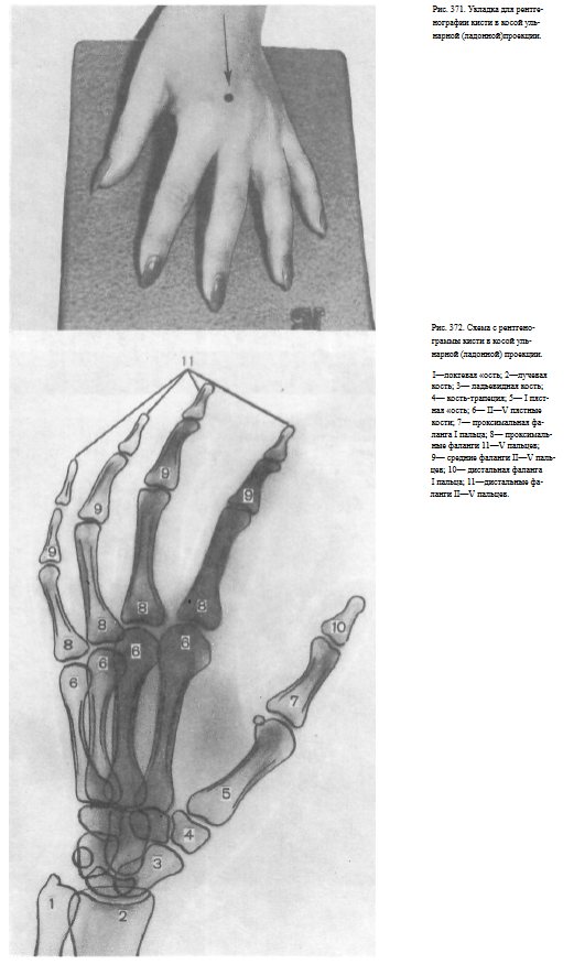 Описание рентгенограмм кисти при переломах