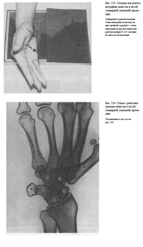 Описание рентгенограмм кисти при переломах