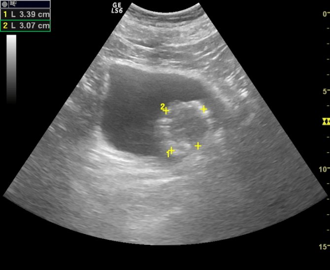 Опухоль мочевого пузыря на УЗИ (обозначена желтыми маркерами)