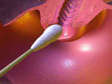 повышенное количество лейкоцитов в мазке у мужчин