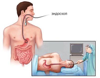Процедура проведения гастроскопии