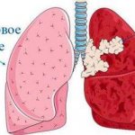 Рак лёгких