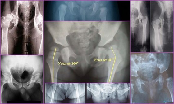 Рентген при дисплазии тазобедренного сустава у малышей