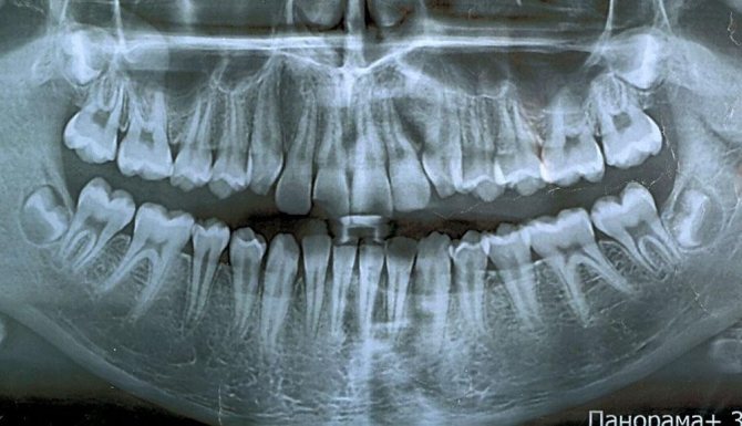 рентген зубов