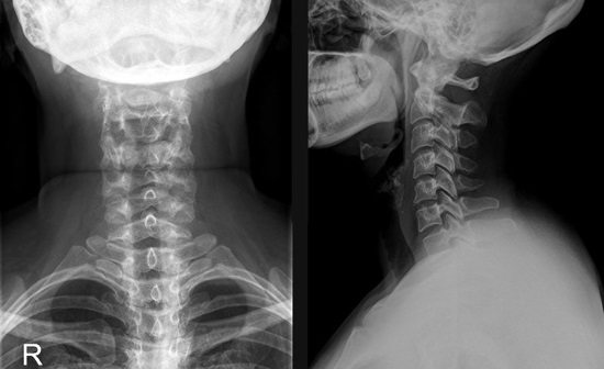 Рентгенограмма шеи в двух проекциях