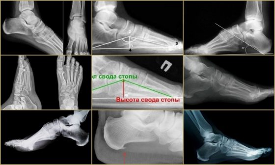 Рентгенологические снимки здоровой стопы и различных патологий
