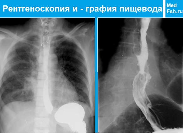 Рентгеноскопия и - графия пищевода