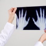 Рентгеноскопия кистей рук