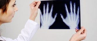 Рентгеноскопия кистей рук