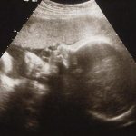 Результат УЗИ на 32 неделе беременности