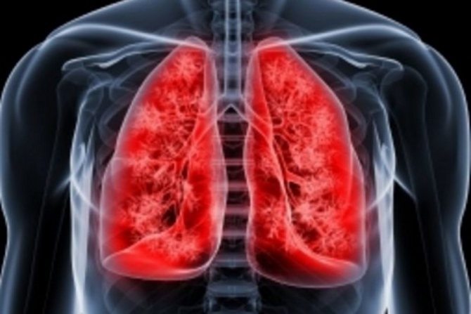 Симптомы кавернозной формы туберкулеза легких
