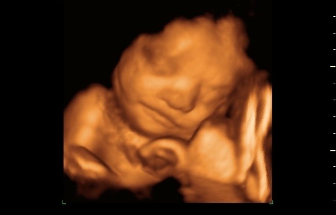 Снимок 3Д УЗИ на 32 неделе беременности