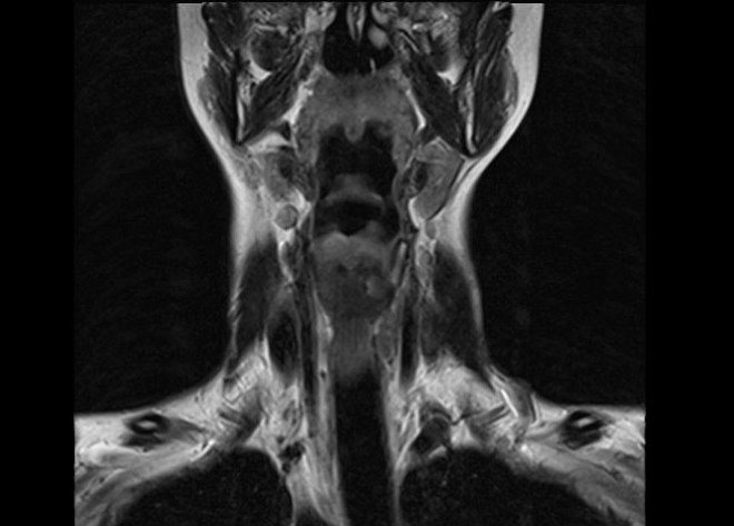 Снимок МРТ мягких тканей шейного отдела