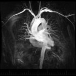 Снимок МРТ сердца и сосудов с контрастированием