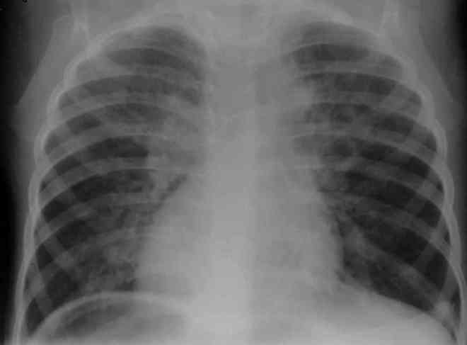 Снимок сердца на рентгене