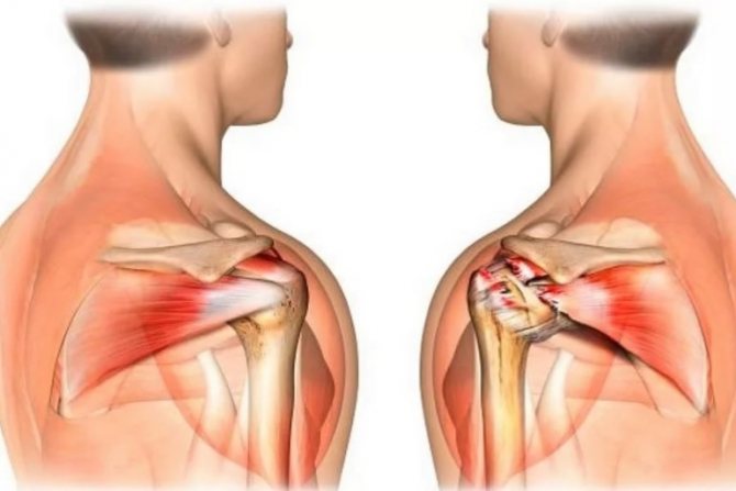 Состояние сухожилия двуглавой мышцы