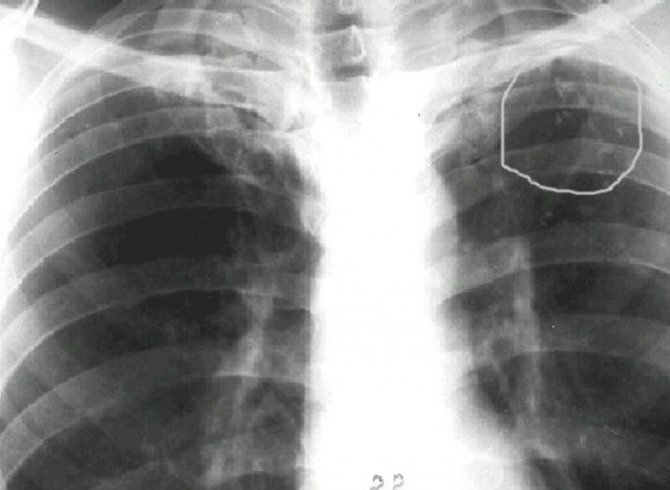 Туберкулез на флюорографии (кальцинаты)