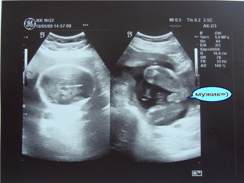 УЗИ на 12 неделе беременности: фото, пол ребенка, размер плода