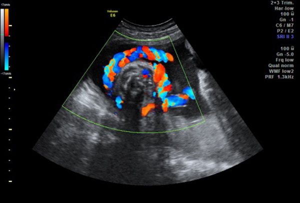 УЗИ с цветной допплерографией плода с изображением обвитой вокруг шеи малыша пуповиной