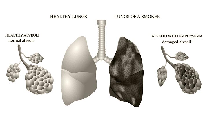 заболевания легких у курильщиков